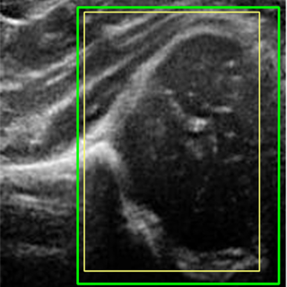Hip ultrasound with detected femoral head